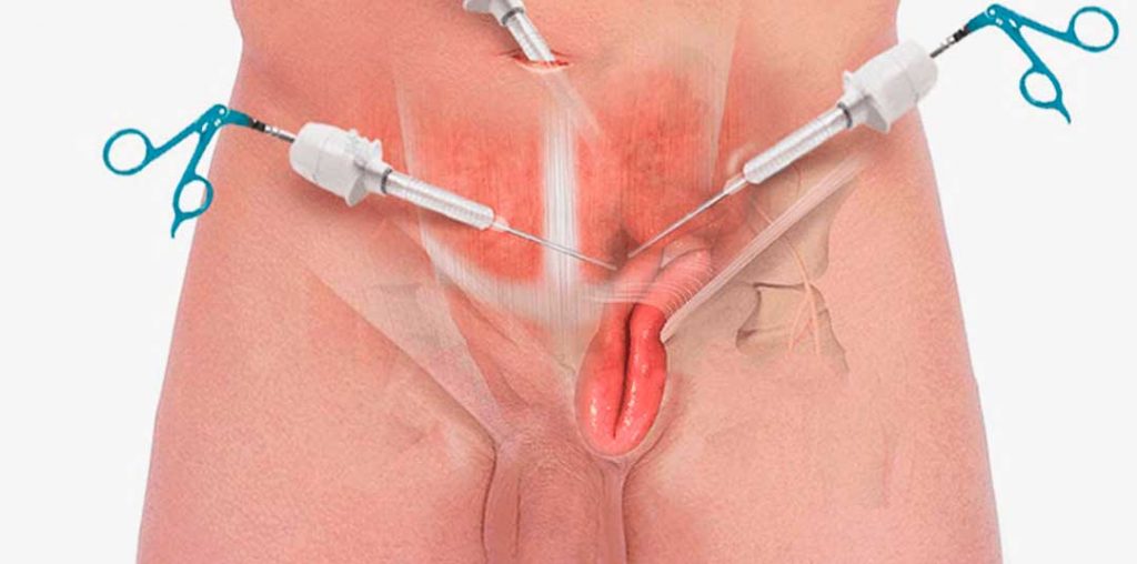 Hernia de Pared Abdominal Esquema