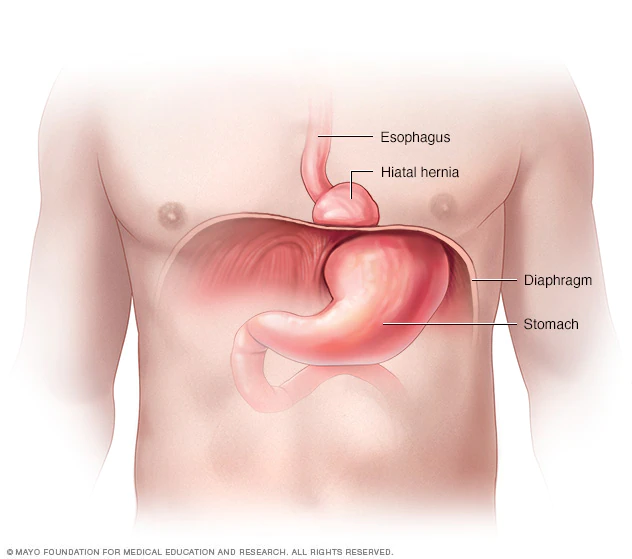 HERNIA HIATAL