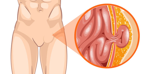 HERNIA INGUINAL 1