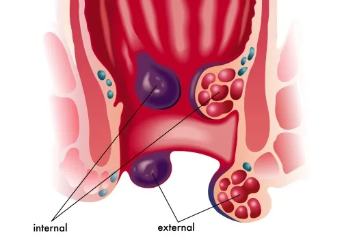Hemorroides-lo-que-hay-que-saber-sobre-ellas