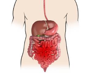 PERITONITIS