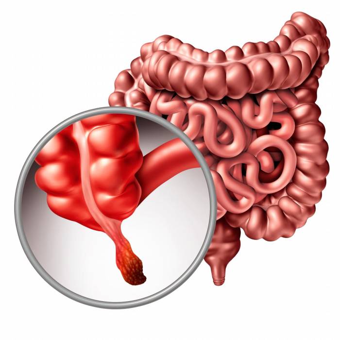 apendicitis-aguda-detalle-andres-perez-grassano