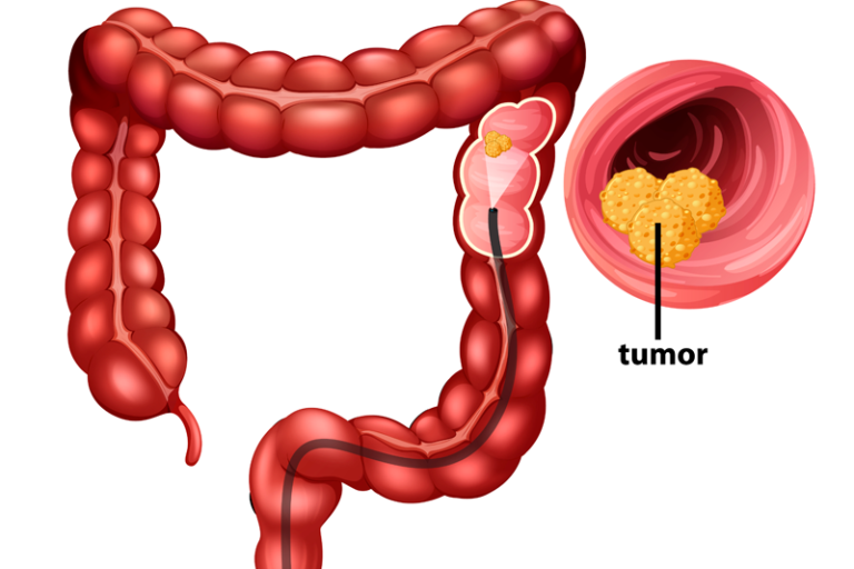 cancer-de-colon