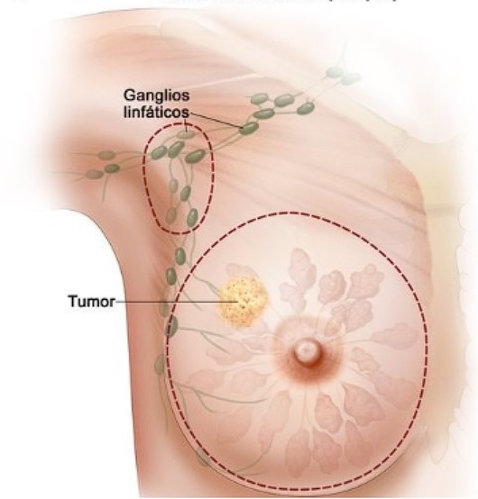 tumor_ de mama