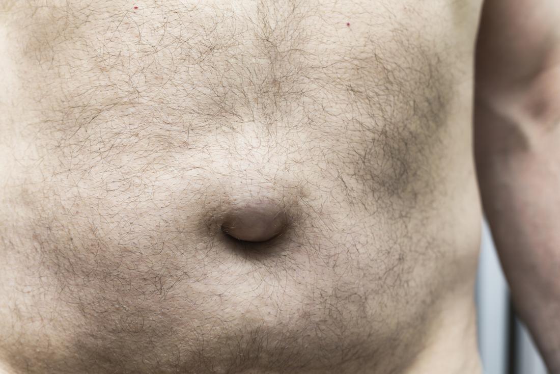 Hernia Umbilical e Inguinal Diagnóstico