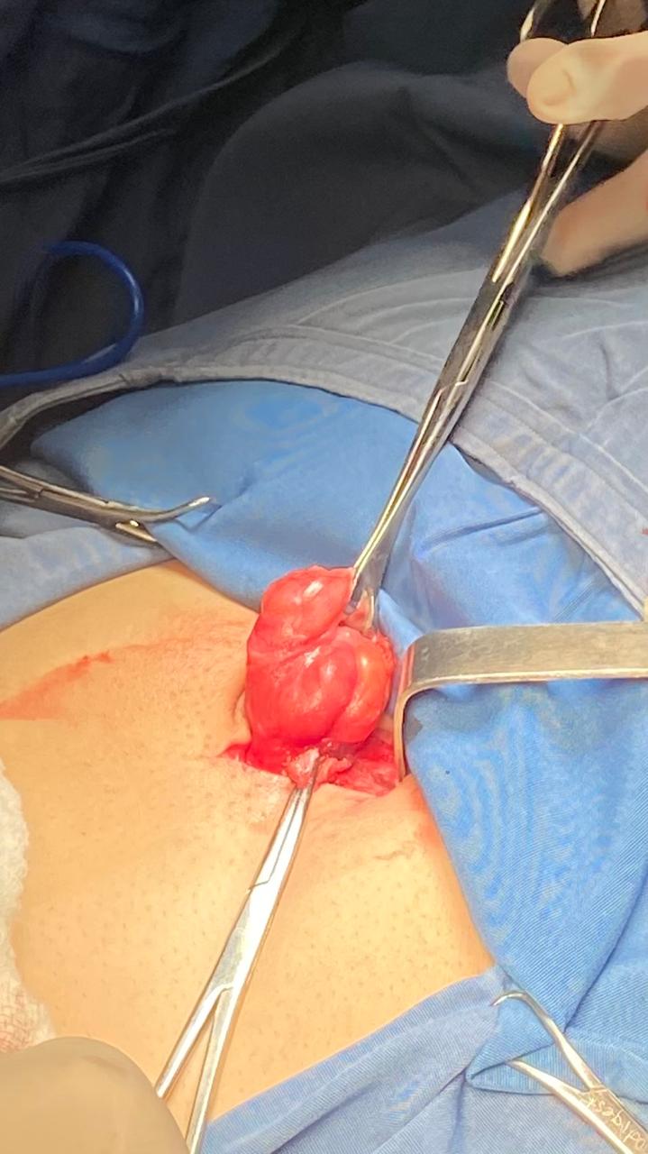 Proceso Sonodigest Tiroides